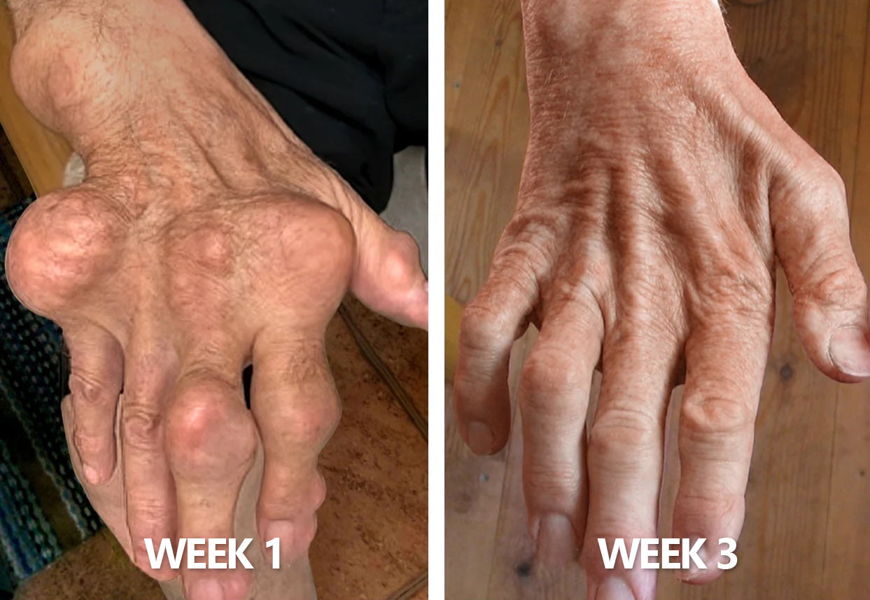 30% Discount🎁🎁|𝐌𝐔𝐑𝐖𝐎𝐍® Bee Venom Pain-Relief Bone Healing Cream ✨✨✨(Specially for older adults)